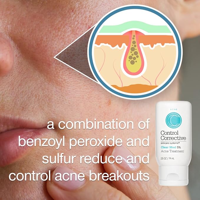 CONTROL CORRECTIVE Clear Med 5% Acne Treatment Lotion, 2.5 Oz - Helps Clear & Control Breakouts, Benzoyl Peroxide, 3% Sulfur To Improve Efficacy And Dry Up Blemishes