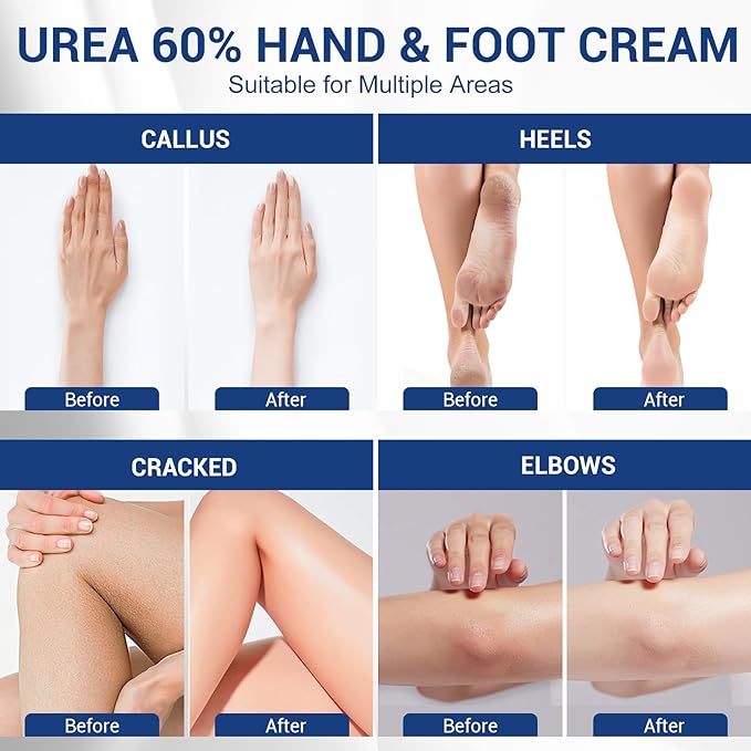 60% Urea Plus 2% Salicylic, Acid Foot Cream, Heel Balm Stick Aloe Vera, Urea Foot Cream, Nourish Foot Care, Heel Stick for Cracked Feet Hands, Knees, Hydrates & Exfoliates