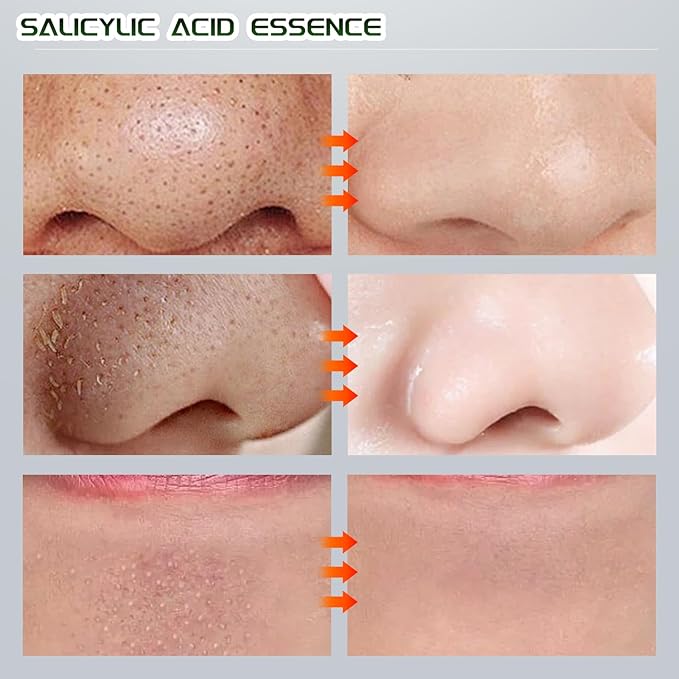 Salicylic Acid Serum, 60ml Blackhead Remover Essence and 25 Pcs Nose Pore Strips, Deep Cleansing Dirts, Pores, Skin Oil, Purifying Peeling, Black White Head Acne Removal for All Skin Type