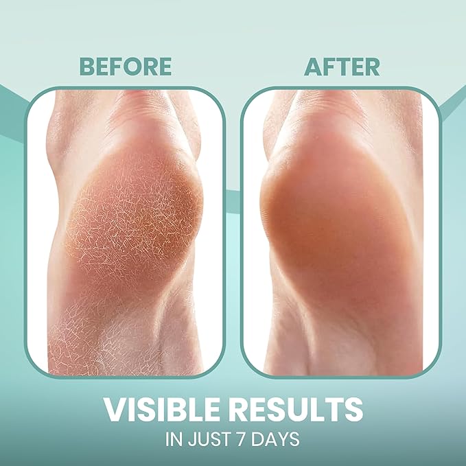 Moisturizing Heel Socks for Cracked Heels - Gel Socks for Dry Cracked Feet Repair - Silicone Socks for Women’s Foot Treatment & Overnight Hydration (Turquoise, 2-Pair)