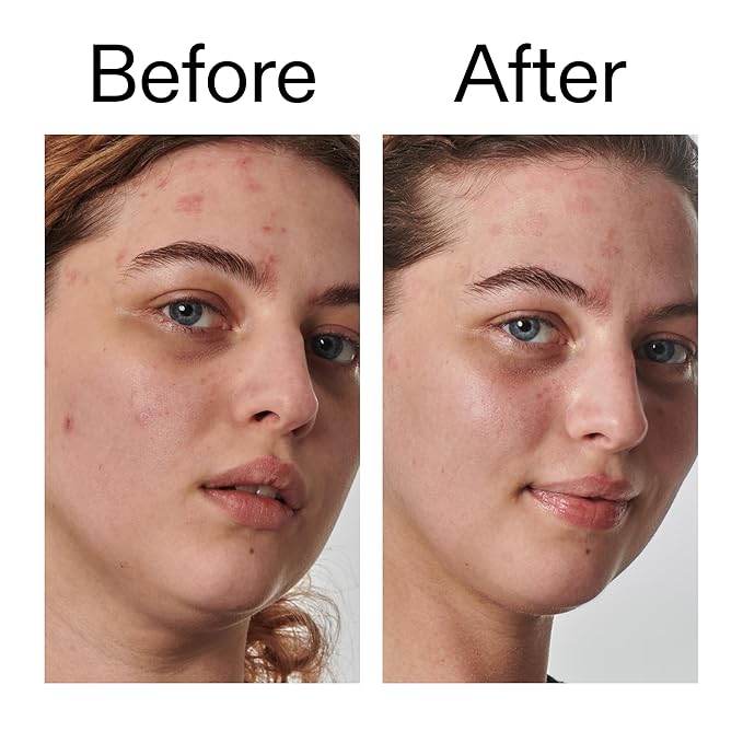 The INKEY List SuperSolutions Urea 10% Moisturizer, Quickly Helps to Hydrate, Nourish and Soothe Dry Skin, Gently Exfoliates, Urea Moisturizer for Face, 1.69 fl oz