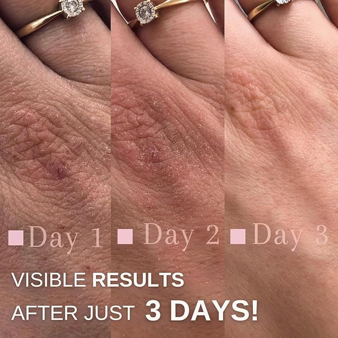 swederm Hudsalva 3.37 Oz - Healing Ointment with Vitamin E - Foot and Hand Cream for Women - Full Body Moisturizer for Dry Skin - Quickly Absorbing - Made in Sweden - Pink