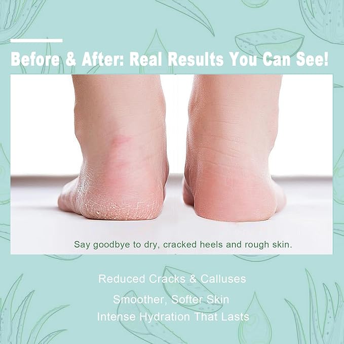 60% Urea Cream for Feet with 2% Salicylic Acid, Foot & Hand Cream for Dry Cracked Heels with Jojoba Oil, Avocado Oil & Aloe Vera, Urea Lotion for Elbows, hands, Knees & Callus Remover, 8.45 oz