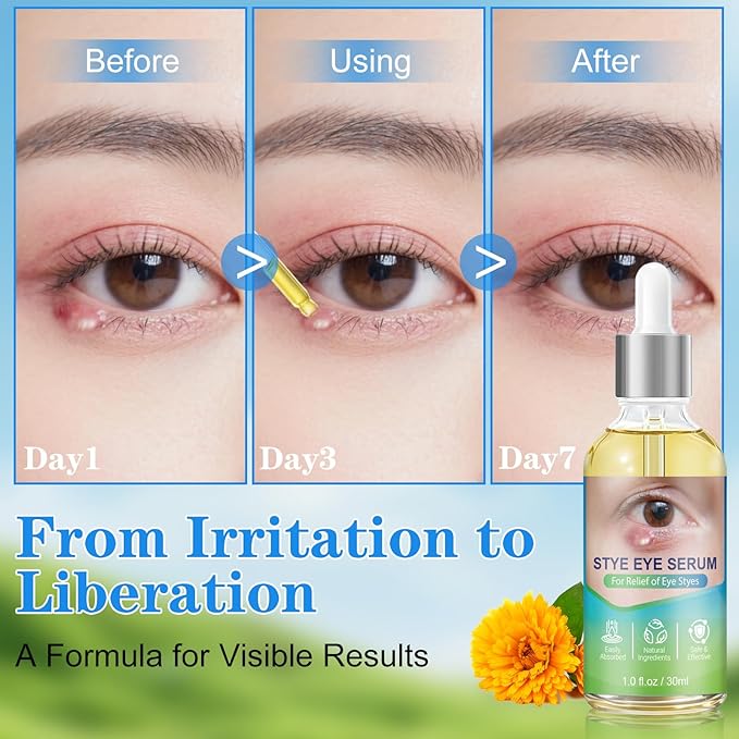 Stye Relief Serum & Eyelid Drops for Blepharitis & Chalazion | Natural Fast-Acting Formula for Lash Line & Under Eye | Gentle Cleansing Care, 1 Fl Oz