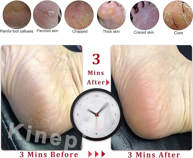 Callus Remover Foot Scrubber Colossal Foot File Foot Care and Foot Exfoliator Foot Rasp Pedicure Tools Pumice Stone for Feet,Remove Corn Hard Skin Dead Skin for Use in Shower Foot Scraper Kit