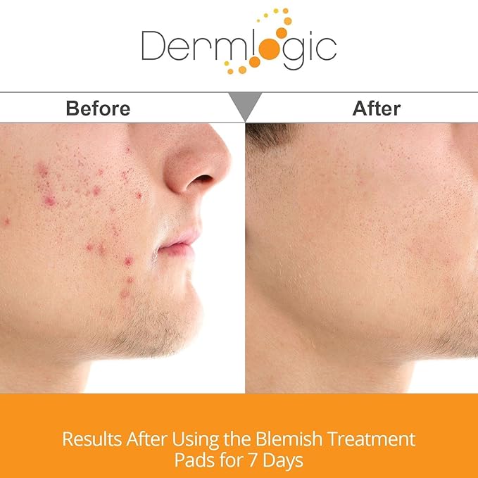 Acne Treatment Pads- Contains Salicylic, Glycolic, & Lactic Acid for Face & Body. Clears Away Clogged Pores, Oily Skin & Cystic Breakouts. Removes Dark Spots, Blackhead & Whitehead Pimples