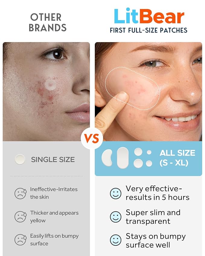 LitBear Large Acne Pimple Patches, 6 Sizes 100 Patches for Large Breakouts, Acne Patches for Face, Chin or Body, Acne Spot Patch with Tea Tree & Calendula Oil, Hydrocolloid Bandages for Acne Skin
