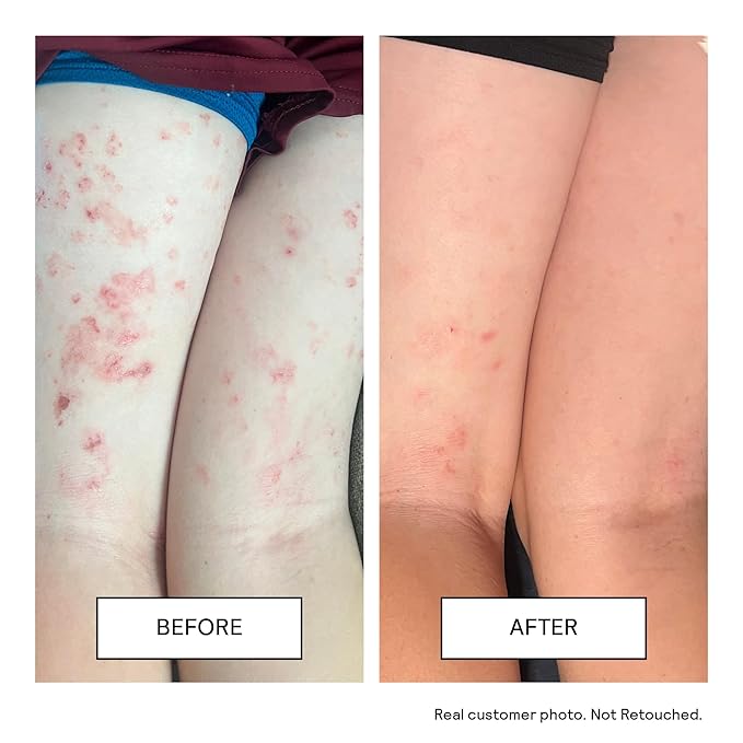 Untoxicated Moisturizing Cream - Facial Moisturizer & Body Cream for Sensitive Skin and NEA Approved for Eczema Relief - Ceramides & Hyaluronic Acid with No Common Irritants