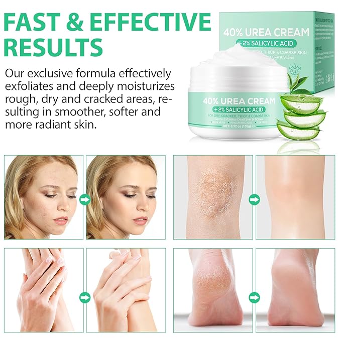 40% Urea Cream for Feet (3.52 oz), Foot Cream for Thick, Cracked, Rough, Dead & Dry Skin, Foot Lotion with 2% Salicylic Acid, Tea Tree , Aloe Vera, Moisturizer For Feet, Elbows, Hands & Knees