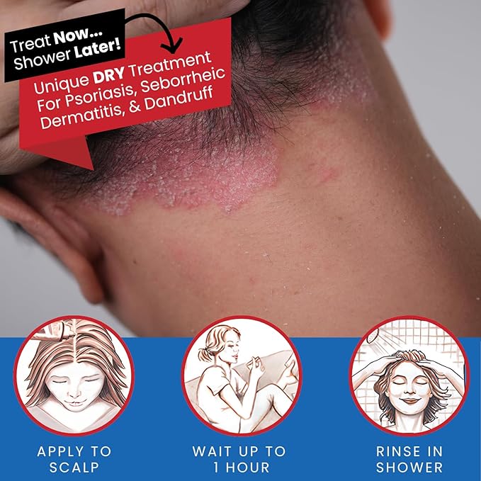 Tarsum Extra Strength Psoriasis Shampoo - Coal Tar Shampoo and Conditioner for Scalp Psoriasis, Seborrheic Dermatitis, Severe Dandruff, & Eczema - Exfoliating Relief for Flaky, & Itchy Scalp (8 oz)