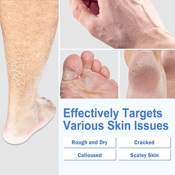 Ultra-Hydrating Urea Cream (Urea Conc. 40.67%), Foot Cream for Dry Cracked Heels and Feet, Pair with Moisturizing Heel Socks for Cracked Heel Treatment, Heel Socks Included (5.29 OZ/150g)