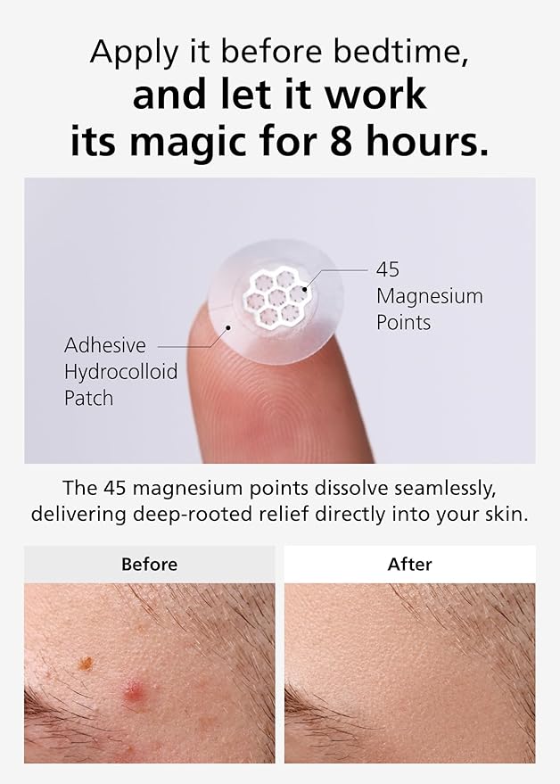 EasyDerm Quick Calming Magnesium Patches – Hydrocolloid Acne Spot Treatment Includes Tweezers & Ampoule, 10 Patches, Zit Sticker, Made by Daewoong Pharmaceutical