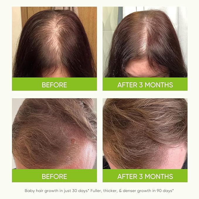 Svvimer Hair Growth Serum Spray - with Rosemary Batana Oil Biotin for Hair Loss and Thinning - Thicker Fuller Longer - for Women and Men 2.7 Fl Oz (Pack of 1)