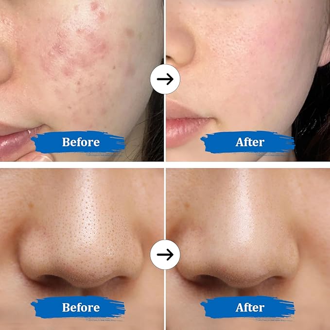 GUGUG Skin Scrubber 4-in-1 Waterproof Facial Spatula for Deep Cleansing, Blackhead Removal Tools, Pore Cleaner for Face