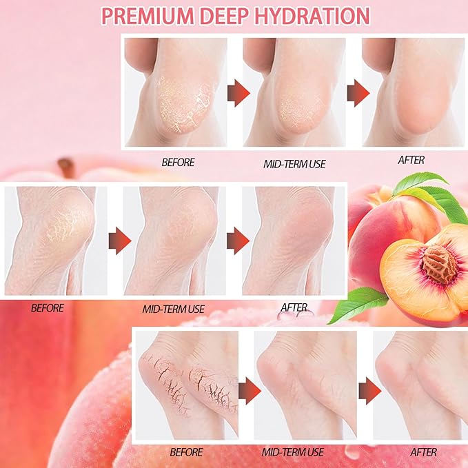 60% Hydrating Urea Foot Cream,Cracked Heel Stick Plus 2% Moisturising Salicylic Acid, Foot Balm Stick for Removing and Smoothing Cracked Hands Elbows Feet Knees, Peach Scent Heel Balm Repairs Dry Skin