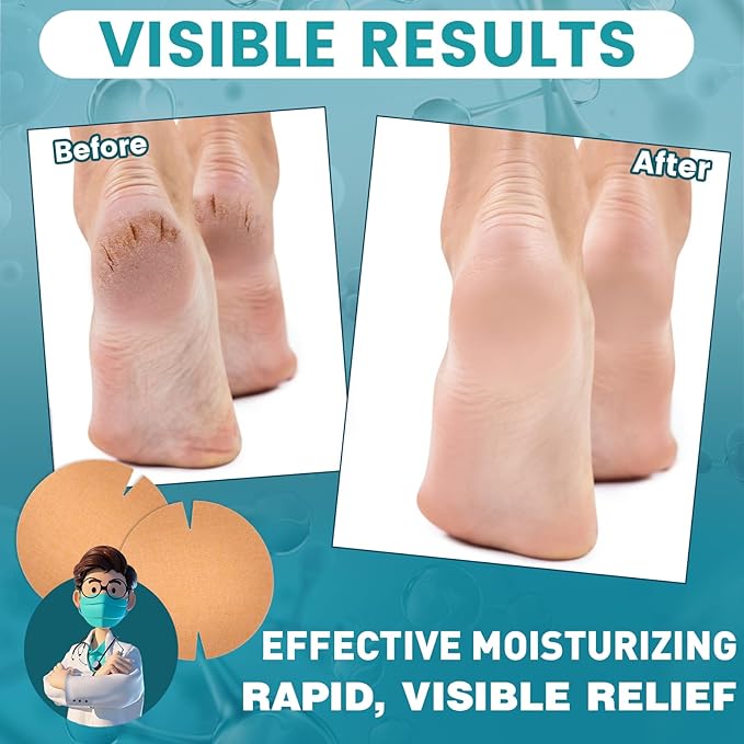 30PCS Patented Cracked Heel Treatment Patches, Cracked Heel Repair Bandage (80mm x 80mm)