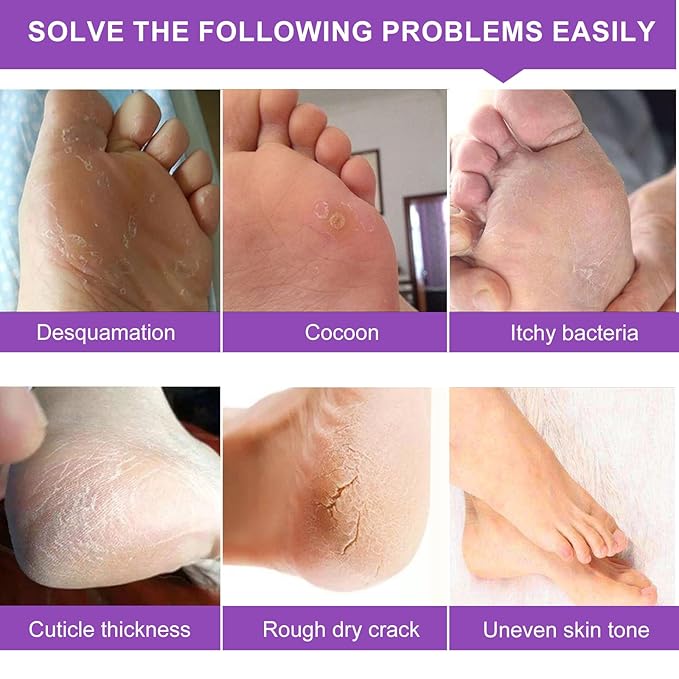 Foot Peeling Mask 5 Pack, Foot Peel Mask Remove Dead Skin, Rough Callus and Cracked Heels, Dry Skin Moisturizer for Soft and Smooth Baby Touch Feet (Lavender)