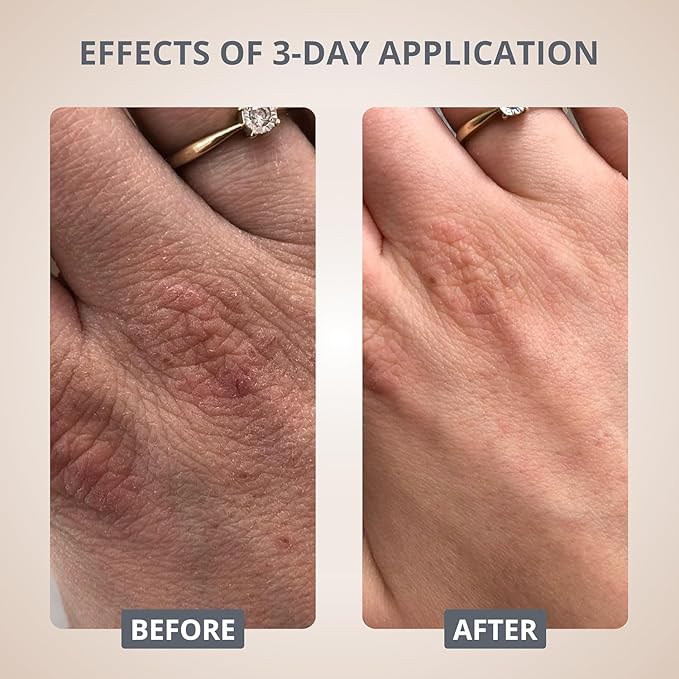 swederm Hudsalva Sensitive 1,69 Oz - Foot and Hand Eczema Cream - Healing Ointment with Glycerine - Full Body Moisturizer for Dry Skin and Callus - Quickly Absorbing - Made in Sweden