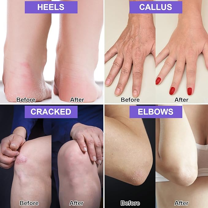 Charmonic Urea Cream 42% Plus Salicylic Acid 2%, Lavender Foot Cream for Dry Cracked Heels Treatment Knees Elbows Hands Repair Treatment, Callus Remover for Feet, Foot Lotion for Dry Cracked Feet