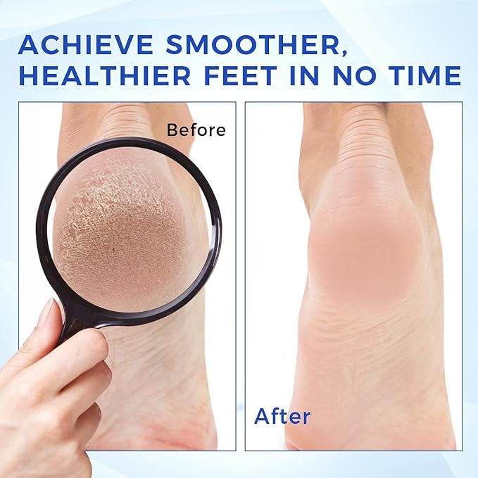 OUKEYA Urea Cream 40 Percent for Foot & Hand Cream with Foot Files for Dry Cracked,Urea Lotion for Feet Maximum Strength