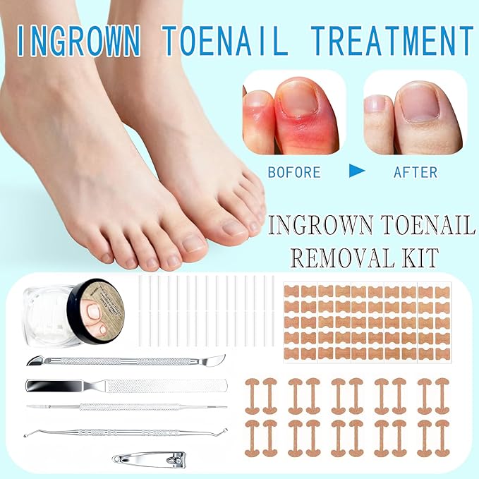 Ingrown Toenail Treatment,Professional Ingrown Toenail Removal Kit,Home Care Nail Clipper Set Suitable for Foot Care Repair