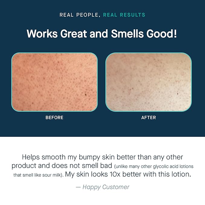 SLMD by Dr. Pimple Popper | Glycolic Acid Body Lotion | Exfoliating Glycolic Acid Lotion Body for Rough, Bumpy Skin and Skin Prone to KP, Ingrown Hairs, Shaving Bumps | 10% AHA - 6 fl. oz.