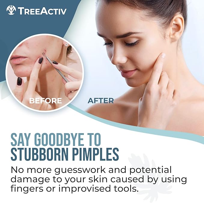 TreeActiv Pimple Popper Tool Kit with Face Wash and Acne Patches, Professional Blackhead Remover Tools Facial Kit, Stainless Steel Blackhead Extractor Tool, Blemish Blackhead & Whitehead Pimple Extr