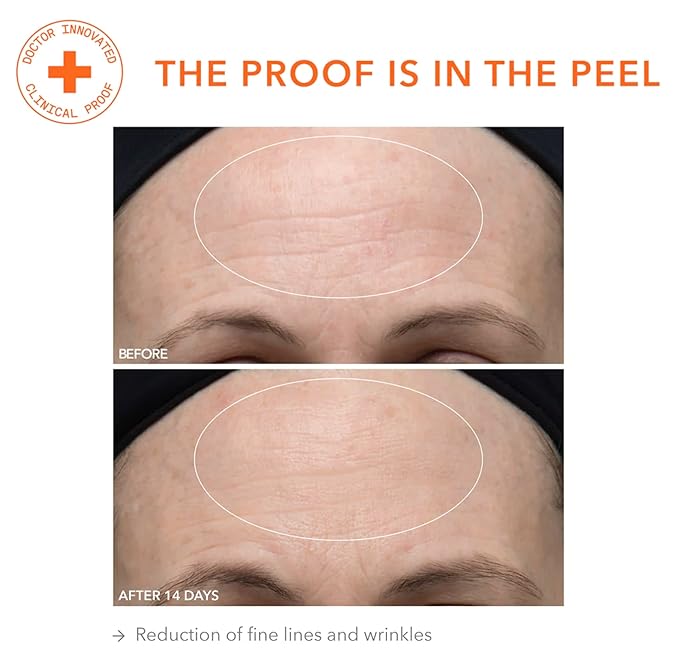 Dr. Dennis Gross Alpha Beta Ultra Gentle Daily Peel: for Dehydrated or Sensitive Skin, Uneven Tone or Texture, Fine Lines or Enlarged Pores (30 Treatments)