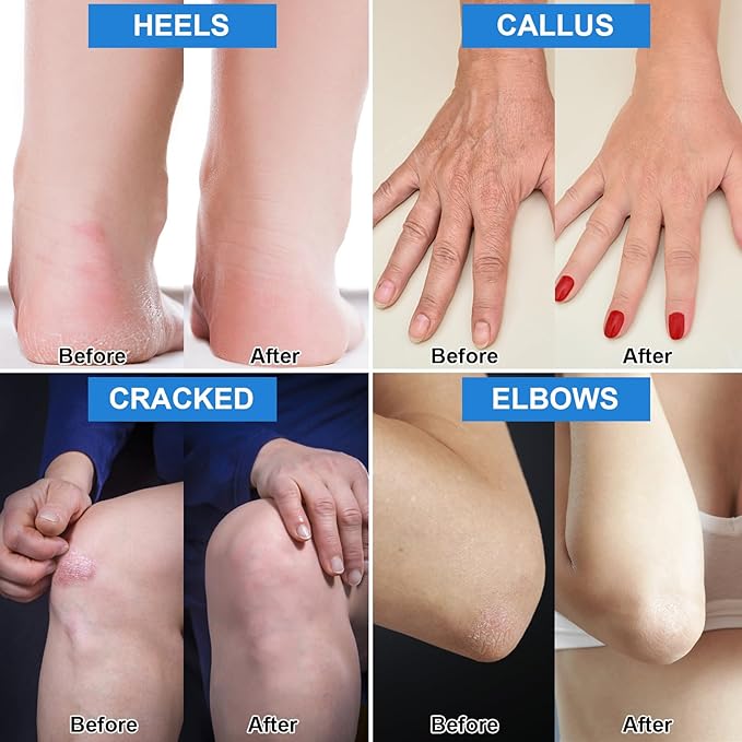 7.06OZ / 2 Pack Urea Cream 42% Plus Salicylic Acid 2%, Urea Foot Cream for Foot Care Cracked Heel Treatment Knees Elbows Hands Repair Treatment, Feet Moisturizer Corn Callus Dead Skin Deep Moisturizes