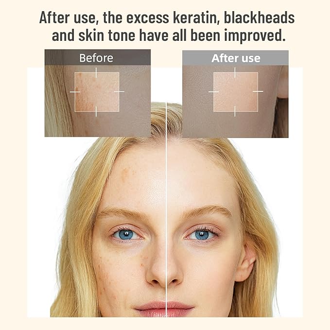 Rice Peel Shot Exfoliating Essence - Gentle Daily Formula withc & Niacinamide, Helps Renew Skin Texture, Reduce Dullness & Blackheads, Pore Refining Solution, 3.38FL.OZ