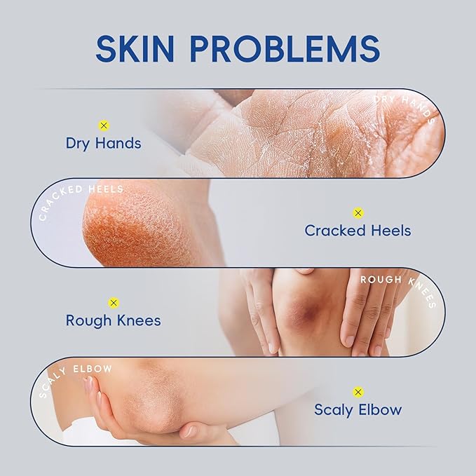 2 Pack Urea Cream 40% + 2% Salicylic Acid, 3.53 oz - Maximum Strength Foot & Hands Moisturizer for Rough, Dry Cracked Skin, Callus Remover with Deep Hydration, Intensive Repair for Feet, Heels