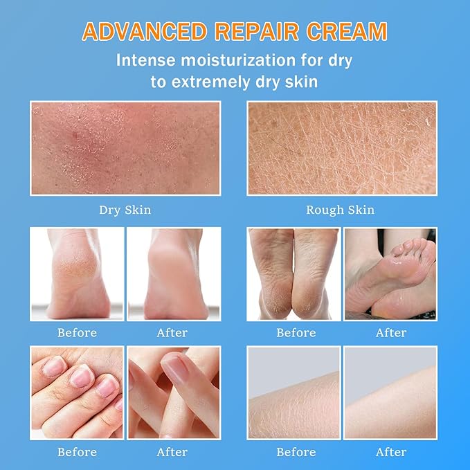 Urea Cream 60% - Urea Foot Cream with Moisturizing Heel Socks for Dry Cracked Hands Heels, 60 Percent for Feet Maximum Strength with 2% Salicylic Acid, Jojoba Oil, Aloe Vera, 5.31oz (Blue, 5.3oz)