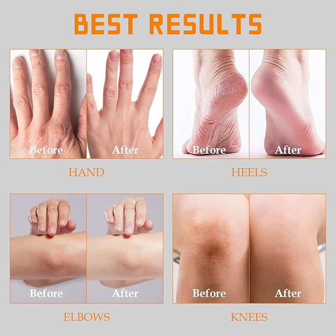 Fragrance Free 60% Urea Cream plus 2% Salicylic Acid, for Dry Cracked Hands Knees Feet Heels, Repair Unscented Foot Cream for Dead Skin, Lotion for Moisturizing and Softening 6.76 OZ