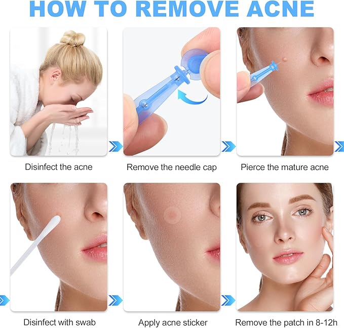 50PCS Disposable Acne Needle & 72 Dots Pimple Stickers - Ultrafine Pimple Popper Needle