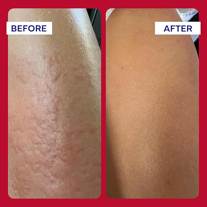 emuaid EMUAIDMAX Ointment for Itchy Skin, Maximum Strength Treatment for Athlete's Foot, Psoriasis, Jock Itch, Rash, Eczema, Cold Sores, Blisters, and Yeast Infection 2oz