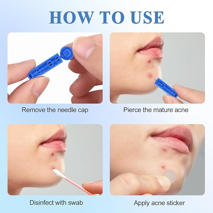 Acne Needle, 50 Pcs Disposable sterile Needles and 70 Dots Pimple Stickers for Acnes, Whitehead, Comedone Removal (122 Piece Set)