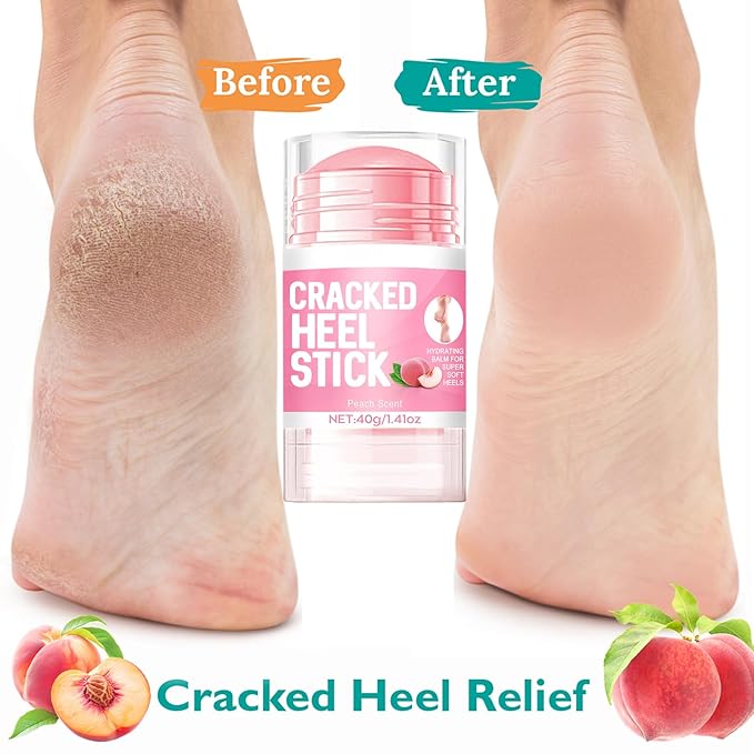 60% Hydrating Urea Foot Cream,Cracked Heel Stick Plus 2% Moisturising Salicylic Acid, Foot Balm Stick for Removing and Smoothing Cracked Hands Elbows Feet Knees, Peach Scent Heel Balm Repairs Dry Skin