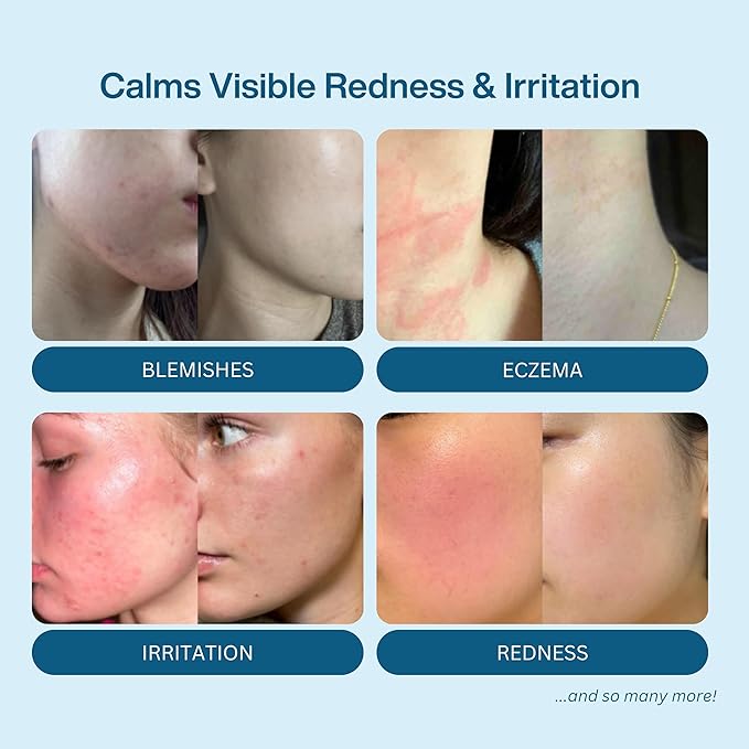 Hypochlorous Acid Spray – Dermatologist Tested HOCl Facial Cleanser for Sensitive, Acne-Prone & Irritated Skin – Soothes Redness, Eczema, Rashes & Itching – Skin Repair Spray, 6.8 oz - Honeydew Labs