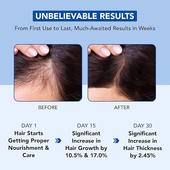 Botanic Hearth 100% Pure Rosemary Oil for Hair Growth (6.7 fl oz)| Infused with Biotin, Jojoba & Castor Oil | Hair Oil Repairs Dry Damaged Hair, Strengthening, Healthier Hair- Hair Tonic