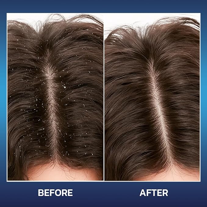 Anti Dandruff Shampoo for Men with 3% Salicylic Acid – Deep Clean & Soothing Scalp Refresh for Oily & Itchy Scalp, Sulfate Free with Tea Tree & Menthol, 10.14 fl oz