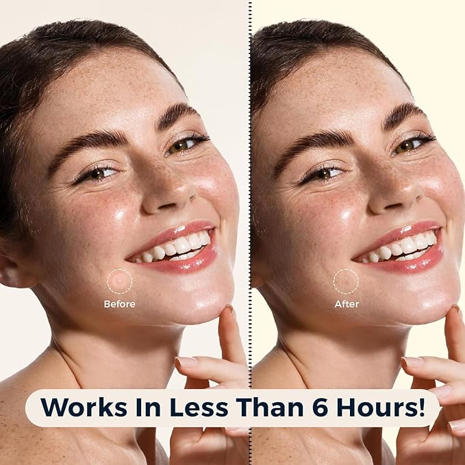 Pimple Patches for a Face Pack of 324, Acne Patches Hydrocolloid Patches for Covering Zits and Blemishes for Skin Care Spot Day and Night with Salicylic Acid, Tea Tree Oil 9 Star Patches