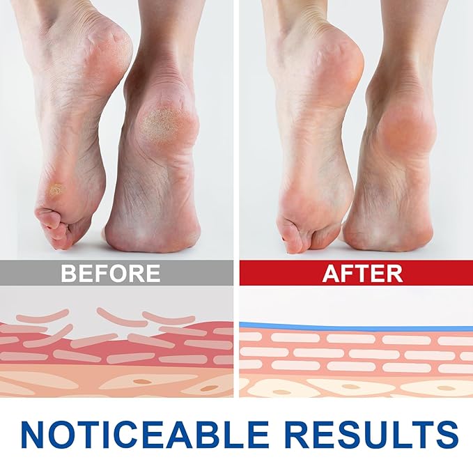 Urea Cream Stick 60% plus Salicylic Acid 2%, Maximum Strength Urea Foot Cream for Dry Cracked Feet, Knees, Hands, Exfoliating Dead Skin, Repairs and Hydrates Feet, Foot Care Cream Moisturizer 2 PCS