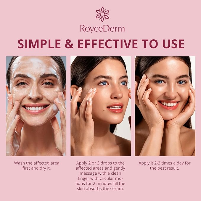 Roycederm Stye Eye Treatment Serum: Natural Stye Remover for Styes Chalazion and Blepharitis - Safe & Fast Relief (0.68 Fl Oz (Pack of 1))