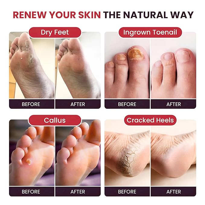 FOOT CURE Foot Soak with Epsom Salts – All-Natural Blend for Relaxing Foot Care – Softens Calluses & Refreshes Feet – Invigorating Scent, Spa Pedicure – 16 oz (Pack of 1)