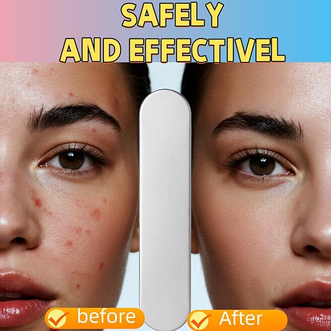 8-Piece Blackhead Remover Tool Kit - Professional Pimple Popper Extractor Set for Acne, Comedones, Whiteheads & Blemishes - Stainless Steel with Metal Case