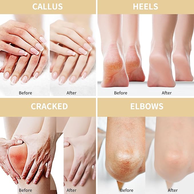 Grocerism Urea Cream 50 Percent for Feet 10.58 oz with Oat and 2% Salicylic Acid, Foot & Hand Cream included Hyaluronic Acid, Tea Tree and Aloe Vera for Deep Moisturizing, Callus Removing