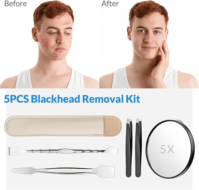 Blackhead Remover Pore Prep Tool Kit, 5PCS: 2× Blackhead Shovels, 2× Hair Tweezers, 1× 5X Mirror, Pimple Popper Tool, Stainless Pore Scraper, Comedone Extractor Tweezer Kit for Acne, Blemish (Black)