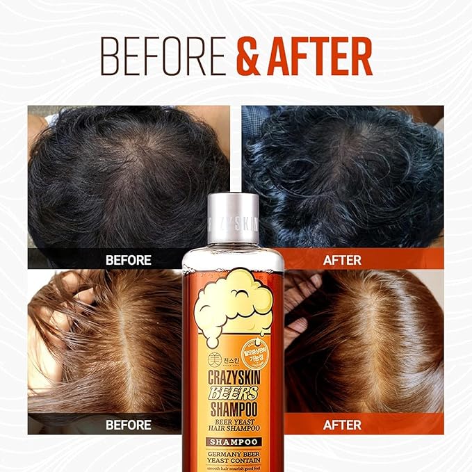 CRAZY SKIN German Beers Shampoo - 20.30 fl oz(300ml) X 2set, BIOTIN for hair loss, Rich with Beer Yeast for Regrowth and Thickening, Sulfate/Chemical free, Suitable for all hair types