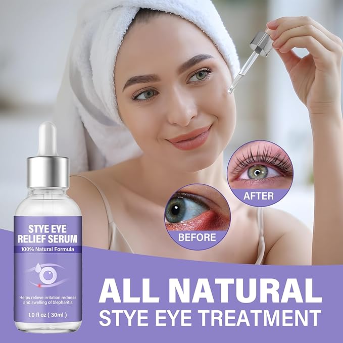 Stye Eye Treatment, Eye Reflief Serum for Styes and Chalazions, Natural & Non-Irritating, Fast-Acting Soothing and Restores Healthier Skin, 30ml