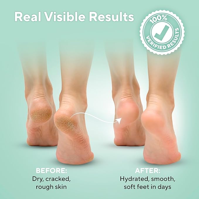 Tea Tree Oil Foot Soak and 40% Urea Cream - for Dry Cracked Feet with Maximum Strength
